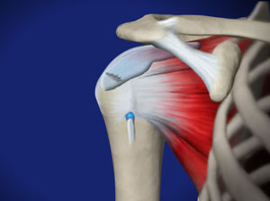 Minimalinvasive Sehnennaht der Rotatorenmanschette nach Ruptur. © Viewmedica Arthroskopische Sehnennaht der Rotatorenmanschette