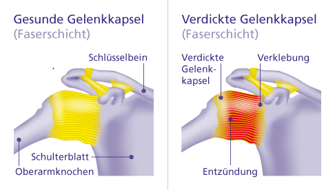 Bei einer adhäsiven Kapsulitis verklebt und verdickt die Gelenkkapsel des Schultergelenks. © Gelenk-Klinik Gegenüberstellung einer gesunden Schulter und einer Schulter mit adhäsiver Kapsulitis