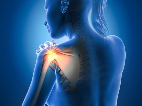 Mechanische Gelenkblockaden können verschiedene Ursachen haben, z. B. Muskelverspannungen oder ein Impingement. © Axel Kock, Adobe blockiertes und schmerzhaftes Schultergelenk
