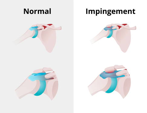 Beim Schulterimpingement kommt es zu einer Blockade unter dem Schulterdach. © alkov, Adobe Stock Grafik Schulterimpingement