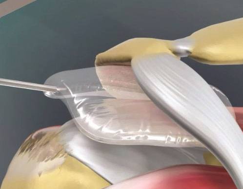 Bei irreparablen Rupturen der Rotatorenmanschette ermöglichen spezielle Implantate die Zentrierung des Schultergelenkes. Diese Inspace™ genannten Implantate verringern akute Schmerzen nach der Ruptur der Rotatorenmanschette und unterstützen den Patienten bei einer kräftigenden konservativen Rehabilitation. Nach etwa einem Jahr hat sich das Implantat auf natürlichem Wege aufgelöst. © Orthospace ltd, Israel, Exactech, Germany Ballonimplantat bei Ruptur der Rotatorenmanschette