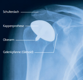 Röntgenbild einer Hemiprothese der Schulter, die den Oberarmkopf wie eine Kappe überkront. © Depuy-Synthes Röntgenbild der Hemiprothese (Kappenprothese) der Schulter