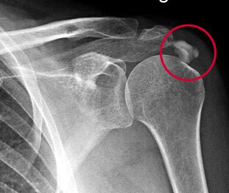 Röntgenbild einer Kalkschulter. Deutlich sichtbar ist die Sehnenverkalkung über dem Schultergelenk (Kreis). © Gelenk-Klinik Kalkschulter im Röntgenbild