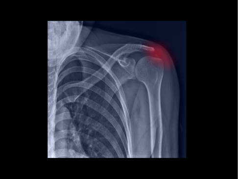 Tendinitis calcarea der Schulter im Röntgenbild. Erkennbar sind Kalkeinlagerungen in die Sehnen der Rotatorenmanschette, die zur Entzündung führen. © Joel bubble ben, Adobe Tendinitis calcarea im Röntgen