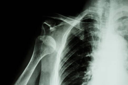 Schulterluxation: Der Oberarmkopf ist aus dem Gelenk ausgekugelt. © stockdevil, iStock Luxation des Schultergelenks