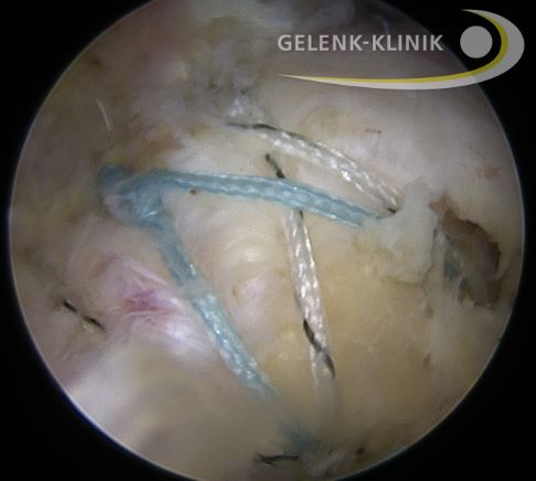 Das arthroskopische Bild zeigt die zweireihige Naht der gerissenen Supraspinatussehne. © Gelenk-Klinik Arthroskopische Naht der Supraspinatussehne