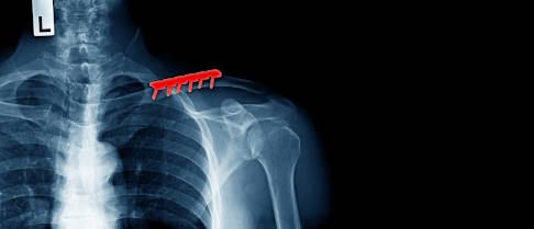 Plattenosteosynthese: Das gebrochene Schlüsselbein wurde mit einer Titanplatte operativ in der richtigen Position fixiert. © angkhan, Adobe Röntgenbild einer operativ versorgten Claviculafraktur