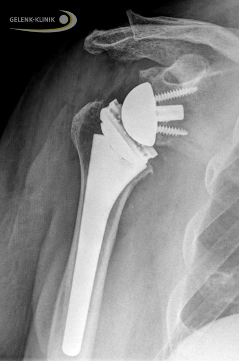 Röntgenbild einer inversen Schulterprothese. © Gelenk-Klinik Röntgen inverse Schulterprothese