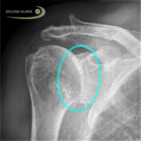 Die Zerstörung der Gelenkfläche der Schulter durch Verschleiß, Unfall oder Krankheit kann eine Schulterarthrose (Omarthrose) verursachen. Das Röntgenbild zeigt den vollständigen Verlust des Gelenkspalts (Markierung). © Gelenk-Klinik Arthrose am Schultergelenk