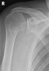 Röntgenbild eines Patienten mit vollständigem Riss der Rotatorenmanschette. Der Oberarmknochen des Patienten berührt das Schulterdach (Impingement-Syndrom). © Gelenk-Klinik Röntgenbild einer Ruptur der Rotatorenmanschette
