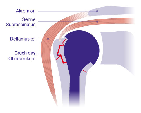 Schematische Darstellung einer Hemiprothese der Schulter. Die Hemiprothese wird zunehmend seltener eingesetzt und ersetzt lediglich die Gelenkfläche des Oberarmkopfes. Bei einem gebrochenen Oberarmkopf erfolgt die Verankerung der Prothese im Schaft (Frakturprothese). Entscheidend für den Erfolg und die spätere Schulterbeweglichkeit ist das Einheilen der Bruchfragmente mit den daran befindlichen Sehnenansätzen an der Prothese. © Gelenk-Klinik Schema Hemiprothese