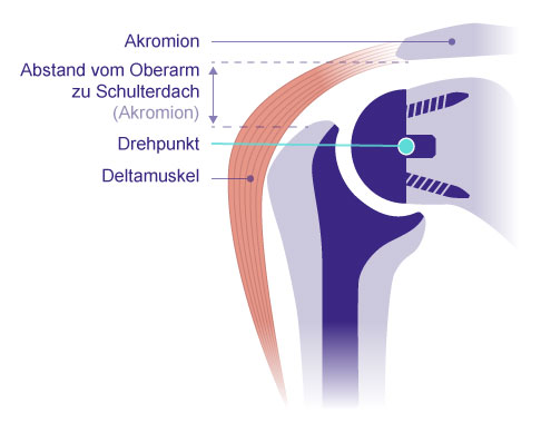 Schematische Darstellung einer inversen Schulterprothese. Sie vertauscht Gelenkpfanne und Gelenkkopf miteinander. Dadurch verschiebt sich der Drehpunkt des Gelenks zur Körpermitte und nach unten (caudal). Der Abstand zwischen Oberarmkopf und Schulterdach vergrößert sich. Der Deltamuskel ermöglicht den Betroffenen, den Arm anzuheben. © Gelenk-Klinik Schema inverse Prothese