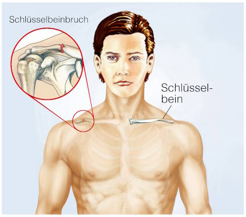 Bei Erwachsenen ist der Schlüsselbeinbruch der zweithäufigste Knochenbruch nach der distalen Radiusfraktur (Bruch der Speiche im Unterarm). © Henrie, Adobe Grafik Schlüsselbeinbruch
