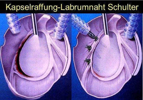 Bei einer Schulterluxation kommt es häufig zu einer Verletzung des Knorpelrings, der die Gelenkpfanne schützend umgibt (Labrum). Labrumrisse können arthroskopisch genäht werden. © Gelenk-Klinik Refixation des gerissenen Labrums nach Schulterluxation