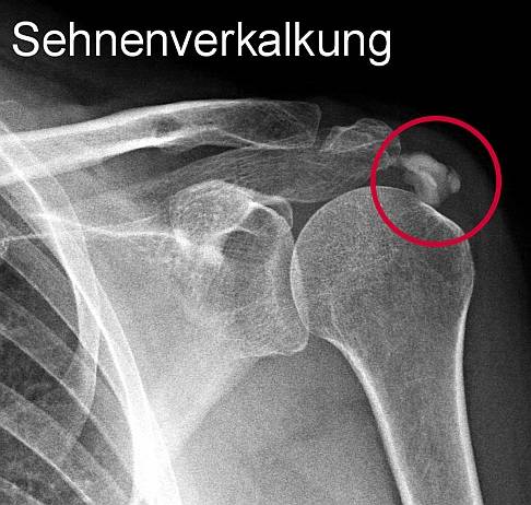 Röntgenuntersuchungen zeigen zum Beispiel schmerzhafte Kalkeinlagerungen im Schultergelenk. © Gelenk-Klinik Untersuchung der schmerzhaften Kalkschulter durch Röntgen