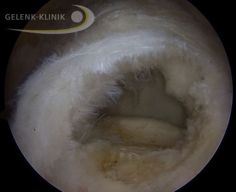 Das arthroskopische Bild zeigt einen vollständigen Riss der Supraspinatussehne. © Gelenk-Klinik Ruptur der Supraspinatussehne