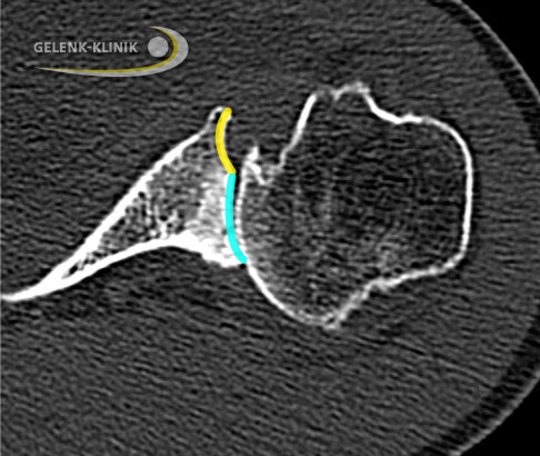 CT einer Schulter mit Omarthrose: Typischer Verlust des Knochens an der Pfanne (Glenoid) im hinteren Gelenkbereich. Durch den arthrosebedingten Knochenverlust entstehen aus der ursprünglich homogenen konkaven Gelenkfläche zwei nach innen gewölbte Vertiefungen (bikonkaves Glenoid). © Gelenk-Klinik Bikonkaves Glenoid bei omarthrose