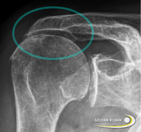 Röntgenbild der Omarthrose bei einer älteren Patientin mit Cuff-Arthropathie. Damit bezeichnet man das Höhertreten des Oberarmkopfes in Richtung Schulterdach (Akromion) durch einen Riss und Verlust der Sehnen der Rotatorenmanschette. © Gelenk-Klinik Cuff-Arthropathie