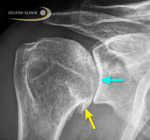 Das Schultergelenk wird vom runden Oberarmkopf (Humeruskopf) und der Pfanne des Schultergelenks (Glenoid) gebildet. Bei Omarthrose zeigt sich der Gelenkverschleiß im Röntgenbild durch einen verschmälerten Gelenkspalt zwischen Pfanne und Oberarmkopf (blauer Pfeil). Zudem kommt es zur Bildung von Knochenanbauten (Osteophyten) am unteren Ende der Gelenkfläche (gelber Pfeil): Schulterbewegungen werden schmerzhaft und das Schultergelenk versteift. © Gelenk-Klinik Schulterarthrose (Omarthrose)
