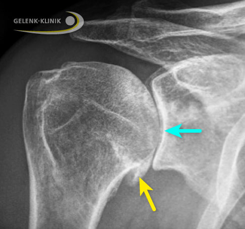 Schulterarthrose (Omarthrose)