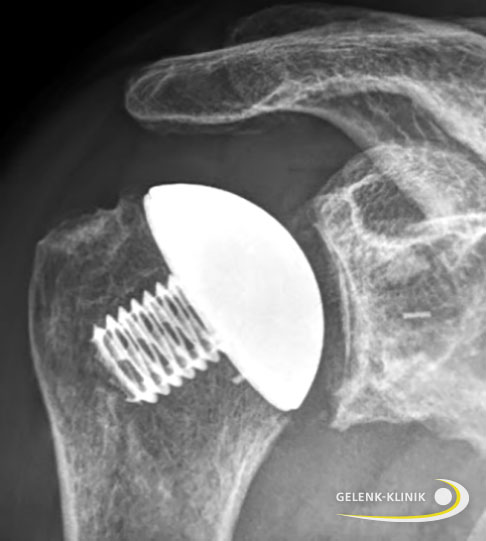 Bei schwerer Omarthrose reicht bei intakten Sehnen der Rotatorenmanschette der Einbau einer Kappenprothese aus (links). Dies ist gerade für jüngere Patienten wichtig, da der Oberflächenersatz im Vergleich zur inversen Schulterprothese eine bessere Schulterfunktion bietet. Der kleine Oberflächenersatz stellt die ursprüngliche Gelenklinie wieder her. © Gelenk-Klinik Mikrofrakturierung bei Omarthrose