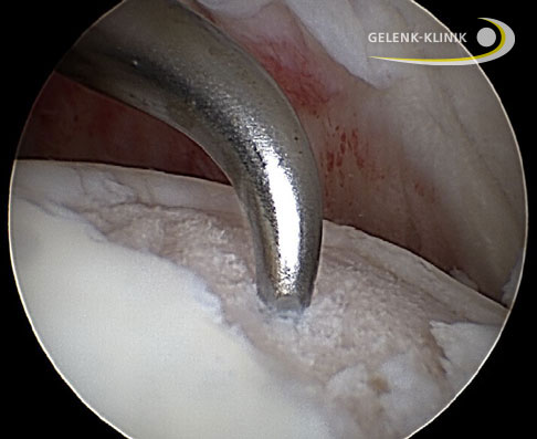 Darstellung eines fokalen Knorpelschadens in der Gelenkfläche des Oberarmkopf. Der Knorpeldefekt wird hier mittels Mikrofrakturierung behandelt. © Gelenk-Klinik Mikrofrakturierung bei Omarthrose