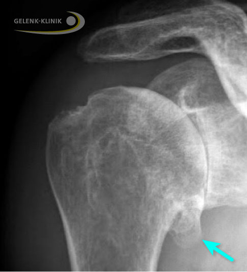 Mechanisch störende Knochenanbauten (Osteophyten, Pfeil) entfernt der Operateur während der Implantation des Oberflächenersatzes. © Gelenk-Klinik Osteophyt bei Omarthrose