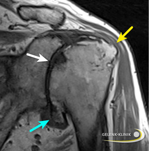 MRT eines durch Arthrose zerstörten Schultergelenks. Der Gelenkspalt zwischen Oberarmkopf und Gelenkpfanne (Glenoid) ist fast verschwunden (Pfeil weiss) Der Oberarmkopf ist entrundet (Pfeil gelb). Es haben sich Zysten und Erosion an beiden Gelenkflächen sowie kräftige Osteophyten (Pfeil blau) gebildet. © Gelenk-Klinik Bikonkaves Glenoid bei omarthrose