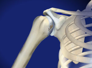 Das Schultergelenk besteht aus dem runden Oberarmkopf (Caput humeri) und der passgenauen, leicht konkaven Pfanne (Glenoid) des Schultergelenks. Beide Gelenkpartner sind mit einer schützenden Knorpelschicht überzogen. Bei Schulterarthrose ist dieser Gelenkknorpel geschädigt und das Aneinanderreiben der Knochen verursacht Schulterschmerzen. © Viewmedica Schulterarthrose (Omarthrose)