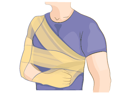 Man bezeichnet den Desault-Verband wegen der Bindenführung auch als Achsel-Schulter-Ellenbogen-Verband. Er dient der Ruhigstellung von Schulter und Oberarm. © Artemida-psy, Adobe-Stock Desault-Verband oder auch Achsel-Schulter-Ellenbogen-Verband, der einer Ruhigstellung von Schulter und Oberarm dient.