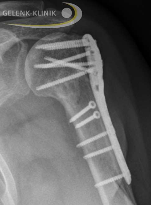 Beispiel einer erfolgreichen Osteosynthese im Röntgenbild. Der Oberarm (Humerus) ist mehrfach im Kopfbereich gebrochen. Die einzelnen Knochenfragmente wurden in einem operativen Verfahren mithilfe von Schrauben und Platten in die anatomisch korrekte Stellung gebracht. © Gelenk-Klinik Röntgen zeigt erfolgreiche Osteosynthese beim Humerusbruch.
