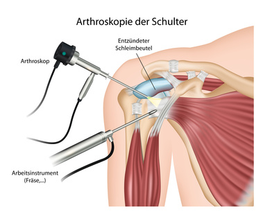 Die Neer-Plastik ist eine Behandlungsmöglichkeit bei einem Impingement-Syndrom der Schulter. Im Rahmen einer arthroskopischen Operation werden strukturelle Veränderungen, die die Schulterenge bewirken, entfernt. Dies können beispielsweise Sehnenverkalkungen oder entzündete Schleimbeutel (Bursitis) sein. © bilderzwerg, Fotolia Subakromiale Dekompression bei Schulter-Impingement