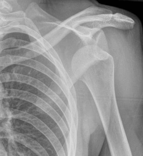 Röntgenbild einer ausgekugelten Schulter nach Schulterluxation: Der Oberarmkopf ist aus der Gelenkkapsel herausgesprungen und hat sich vom Schulterdach entfernt. Bei der Luxation kommt es häufig zu Verletzungen der Weichteile und der knorpeligen Gelenklippe der Gelenkpfanne. Der Patient leidet unter stechenden Schulterschmerzen und einer Lähmung des Arms. Ein Spezialist sollte das Schultergelenk so schnell wie möglich untersuchen und behandeln, um Schäden an Sehnen, Bändern und Knorpel zu verhindern. © Gelenk-Klinik Luxiertes Schultergelenk