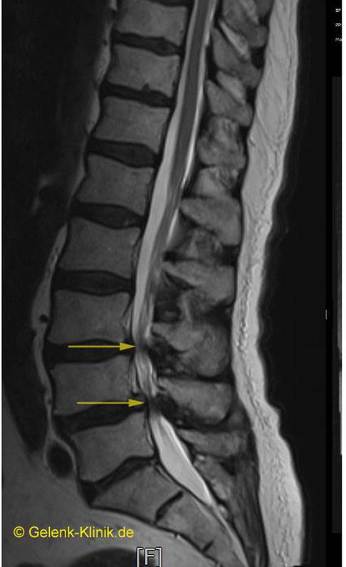 MRT-Bild einer lumbalen Spinalkanalstenose: Die Einengung des Rückenmarks im Bereich der Lendenwirbelsäule ist mit gelben Pfeilen markiert. © Gelenk-Klinik MRT einer lumbalen Spinalkanalstenose