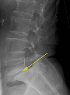 Das Wirbelgleiten ist eine der Hauptursachen für die Stenose oder Einengung des Rückenmarks.© Gelenk-Klinik Wirbelgleiten als Ursache für eine Spinalkanalstenose
