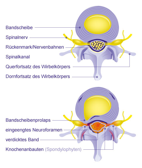 Querschnitt durch eine Wirbelsäule mit gesundem Spinalkanal (oben) und mit Spinalkanalstenose. Der Wirbelkanal ist eingeengt durch Spondylophyten, einem verdickten hinteren Längsband und einem Bandscheibenprolaps. © Gelenk-Klinik Spinalkanalstenose