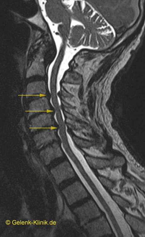 MRT-Bild einer zervikalen (in der Halswirbelsäule lokalisierten) Spinalkanalstenose. Die Einengung des Rückenmarks ist mit gelben Pfeilen markiert. © Gelenk-Klinik MRT Bild einer zervikalen Spinalkanalstenose