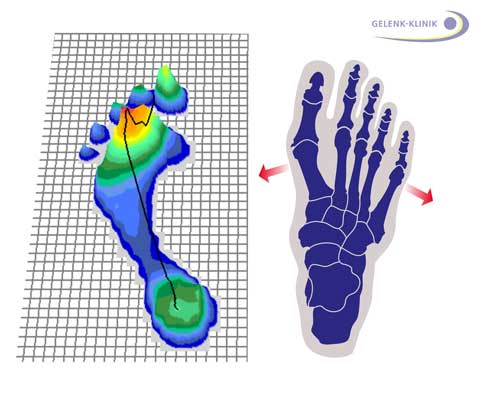 Anatomie und podometrische Untersuchung des Spreizfußes: Eine Platte zeichnet die Verteilung des Körpergewichts auf, das beim Abrollen auf der Fußsohle lastet. Eine Computergrafik stellt die verschiedenen Belastungszonen des Fußes dar. An roten Stellen ist die Gewichtsbelastung besonders hoch, die blauen Bereiche zeigen eine niedrige Gewichtsbelastung. Das Bild zeigt die durchschnittliche Verteilung der Druckbelastung während eines Schrittes. Die Untersuchung wird nicht im Stand, sondern dynamisch während des Schrittes ausgewertet. © Gelenk-Klinik Anatomie und podometrische Untersuchung des Spreizfußes