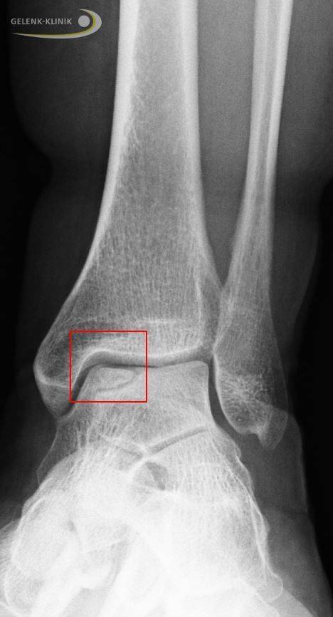Röntgen einer Osteochondrosis dissecans am Sprungbein von vorne. Der dunkle Riss (Markierung) zeigt den geschädigten Knochenbezirk. © Gelenk-Klinik Osteochondrosis dissecans im Sprunggelenk