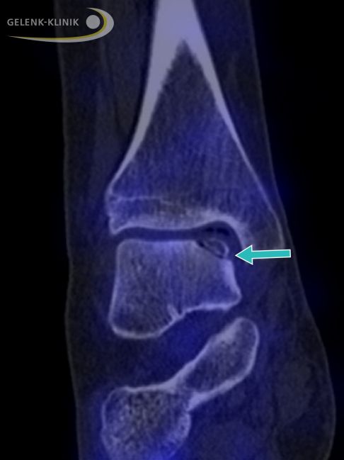 Die Bildgebung zeigt eine Osteochondrosis dissecans mit abgestorbenem Knochenbezirk auf der Innenseite des Sprungbeins (Talus). © Gelenk-Klinik Bildgebung (SPECT) einer Osteochondrosis dissecans mit Knochennekrose