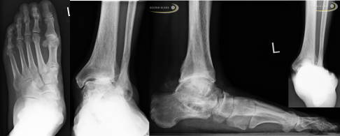 Das Röntgenbild in mehreren Ebenen zeigt knöcherne Veränderungen des Sprunggelenks, die typisch für ein Impingement sind. © Gelenk-Klinik Röntgenbild: Impingement des oberen Sprunggelenks