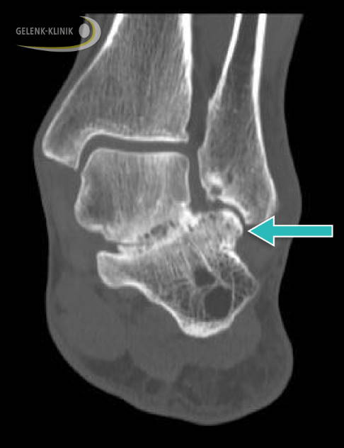 Fibulocalcaneares Impingement: Das Röntgenbild zeigt eine Einklemmung im oberen Sprunggelenk zwischen Wadenbein (Fibula) und Fersenbein (Calcaneus). © Gelenk-Klinik Impingement im oberen Sprunggelenk zwischen Wadenbein und Fersenbein