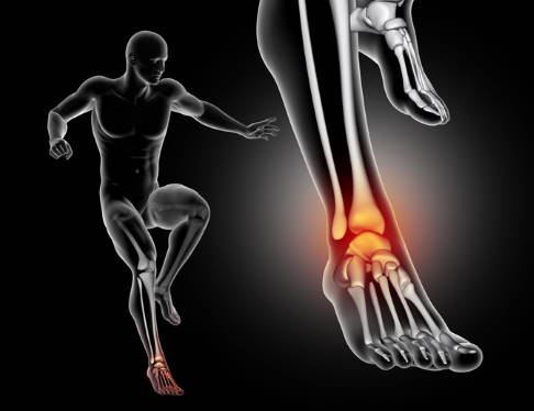 Oftmals sind Sportverletzungen für ein Impingement des Sprunggelenks verantwortlich. © kirstypargeter, istock Impingement im Sprunggelenk