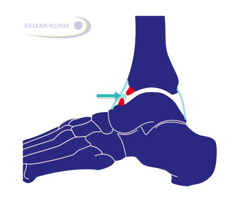 Impingement des oberen Sprunggelenks: Die knöchernen Anbauten am Schienbein (Tibia) und Sprungbein (Talus) führen zu einer Blockade des oberen Sprunggelenks (OSG). © Gelenk-Klinik Impingement des oberen Sprunggelenks