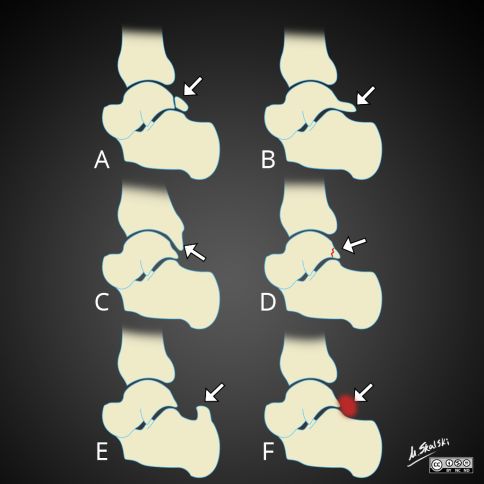Mögliche Ursachen des hinteren (dorsalen) Impingements des Sprunggelenkes. A: Der akzessorische Knochen (Os trigonum) übt schmerzhaften Druck auf den Talus (Sprungbein) und das umliegende Bindegewebe aus. B: Eine verlängerte Ausziehung (Stieda-Fortsatz) des hinteren Endes des Sprungbeins verursacht die Beschwerden. C: Eine stark verlängerte Hinterkante des Schienbeinknochens (Tibia) schränkt die Beweglichkeit ein. D: Im hinteren Fortsatz des Talus (Processus posterior tali) liegt eine Fraktur vor. E: Der Fortsatz des Fersenbeins tritt stark hervor (Haglund-Deformität). F: Das Bindegewebe am hinteren Sprunggelenk ist entzündlich verändert. Ursachen eines knöchernen Sprunggelenksimpingements