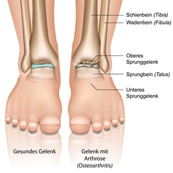 Arthrose im Sprunggelenk