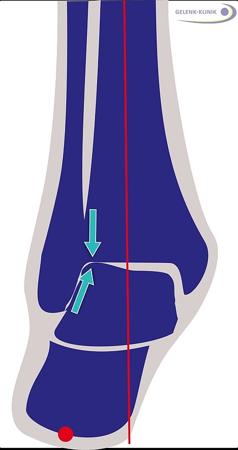 Arthrose im oberen Sprunggelenk wird häufig ausgelöst durch eine Fehlstellung der Rückfußachse im Sprunggelenk. Das kann z. B. durch eine X-Stellung oder O-Stellung des Fersenbeins verursacht werden. Die Korrektur der Fersenbeinstellung ist deshalb eine Maßnahme, die den Gelenkerhalt im oberen Sprunggelenk unterstützt. © Gelenk-Klinik Fehlstellung des Fersenbeins von hinten