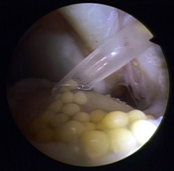In einem minimalinvasiven Eingriff bringt der Operateur die Knorpelzellen an die Stelle des Knorpelschadens. © Gelenk-Klinik Mit minimalinvasiver Operation können die Chondroyzten in den Gelenkspalt eingebracht werden.