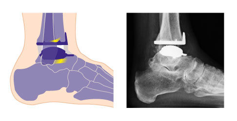 Schema und Röntgenaufnahme einer individualisierten Sprunggelenksprothese. Die Überkronung der belasteten Gelenkflächen von Schienbein (Tibia) und Sprungbein (Talus) reduziert die Gelenkschmerzen. Das bewegliche Inlay aus Polyethylen zwischen den Komponenten vermindert die Belastung der Knochenanteile unter der Prothesenfläche. Die Kraft wird in jeder Fußstellung gleichmäßig übertragen. © Gelenk-Klinik Schema und Röntgenaufnahme einer individualisierten Sprunggelenksprothese.