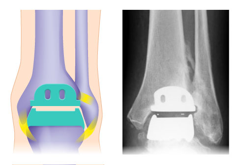 Schema und Röntgenkontrolle einer individualisierten Sprunggelenksprothese (OSG-TEP) von vorne. Zwischen den beiden Metallkomponenten liegt das Inlay, welches für die radiologische Kontrolle der richtigen Lage durch einen Metallmarker markiert ist (links). © Gelenk-Klinik Schema und Röntgenkontrolle einer modernen Sprunggelenksprothese (OSG-TEP)